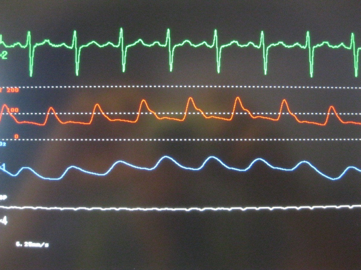 Heart Rate Zones: What the Colours on Your Watch Mean During Intervals
